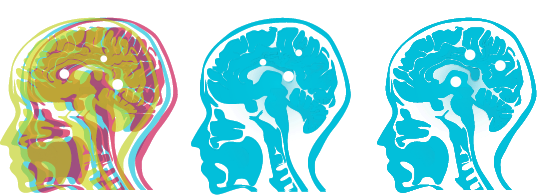 Profile image of 3 brains with brain metastases, with one highlighted to show that one is asymptomatic