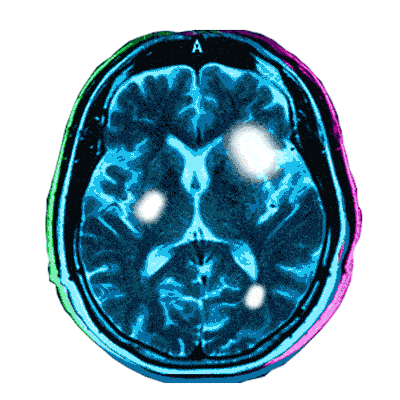 Image of brain scans showing development of brain metastases